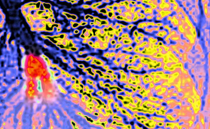 Врачи рассказали, как распознать внезапное образование тромба