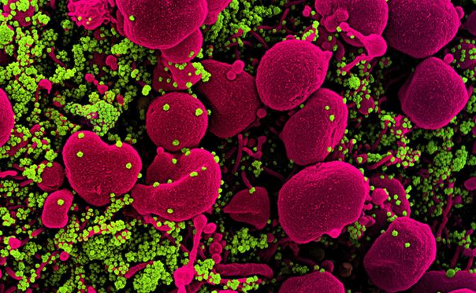 На фото: раскрашенная сканирующая электронная микрофотография апоптотической клетки (розовый), сильно инфицированной частицами вируса SARS-COV-2 (зеленый), выделенной из образца пациента.