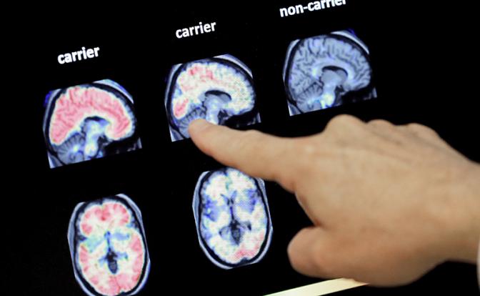 Выяснилось, почему болезнь Альцгеймера быстро прогрессирует