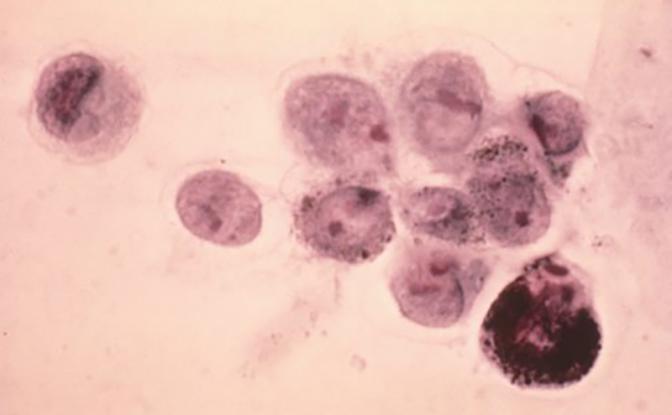 Дерматолог Пассеронн назвал симптом рака кожи