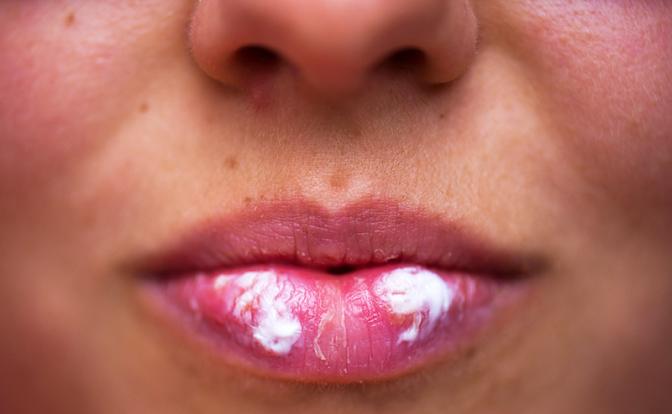 Ученые: обычный герпес может привести к страшной болезни