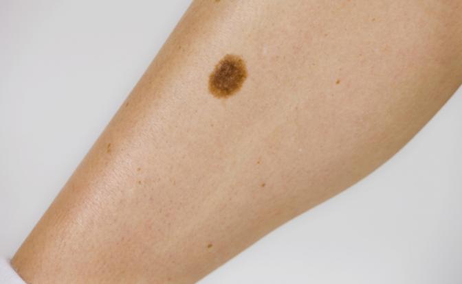 Озвучен распространенный миф насчет родинок