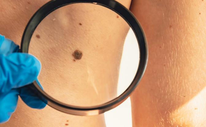 Онколог: После зимы обязательно нужно проверить родинки