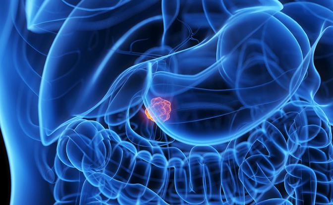 На фото: опухоль поджелудочной железы.