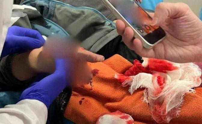 Пришлось ампутировать: Стало известно о состоянии пострадавшего в Красногорске ребенка