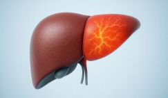 Жирная печень — редкие волосы: ученые обнаружили неожиданную связь