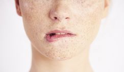 Что нужно знать о лазерной эпиляции при гиперпигментации и склонности к рубцеванию